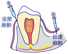 歯科における麻酔